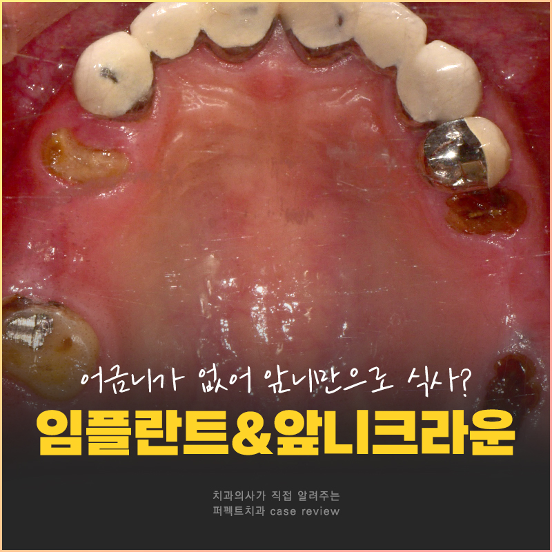 어금니가 없어 앞니로 음식을 드셨던..😰 어떻게 변했을까? 관련 이미지 1