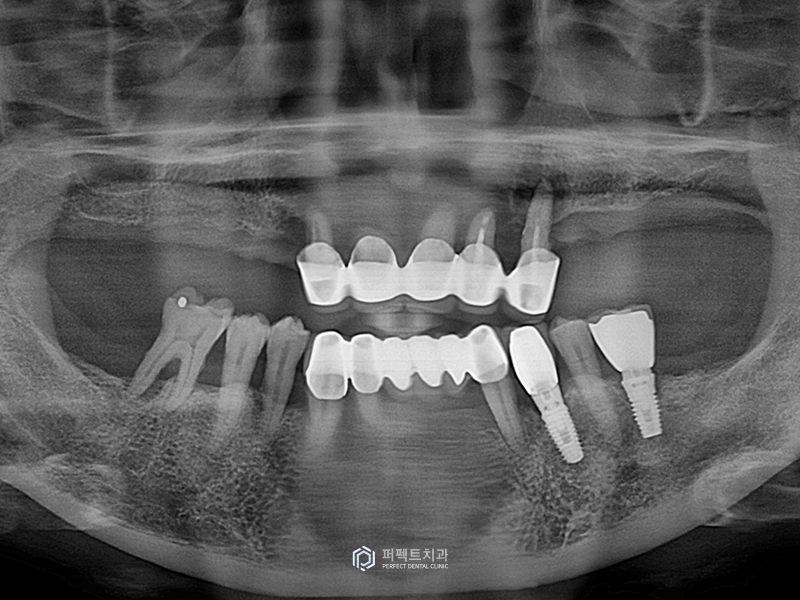 네비게이션 가이드로 전악임플란트를 20분만에? 관련 이미지 2