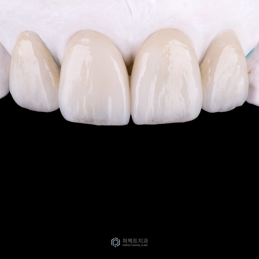 예쁜 라미네이트의 기준이 있나요? 관련 이미지 3