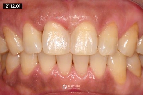 벌어진 앞니, 레진으로 치료 가능? 관련 이미지 5