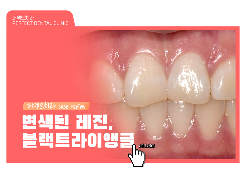 깨진앞니+나비치아 무삭제라미네이트 관련 이미지 1