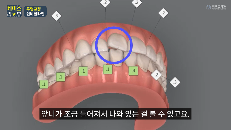 인비절라인 효과 알아보기 (+인비절라인라이트) 관련 이미지 11