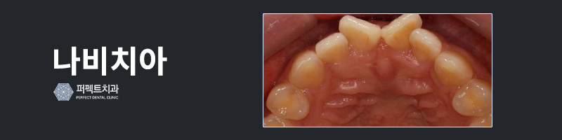 깨진 앞니 치료, 라미네이트로! 관련 이미지 3