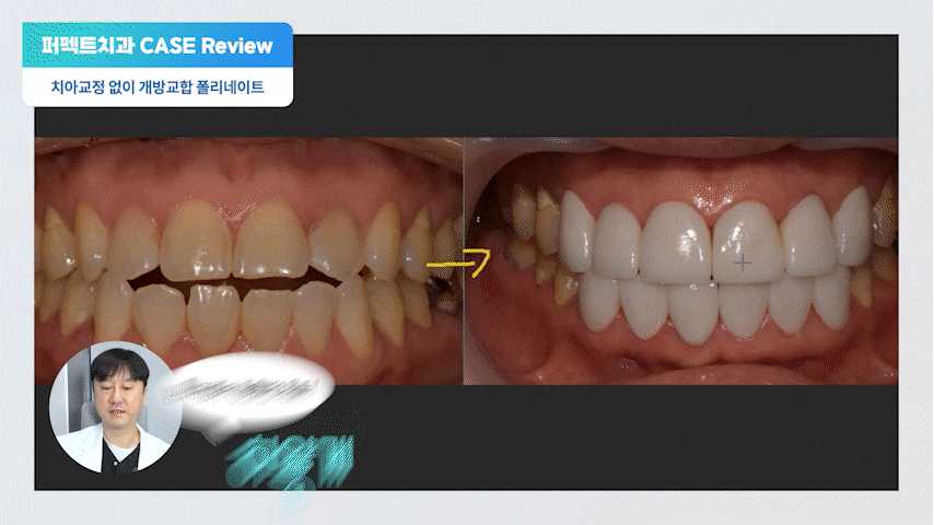 개방교합(open bite)을 라미네이트로 해결할 수 있을까? 관련 이미지 8