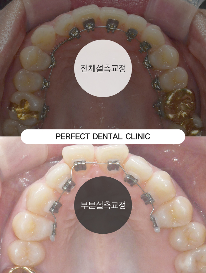 치아안쪽에 교정하는 설측교정! 관련 이미지 4