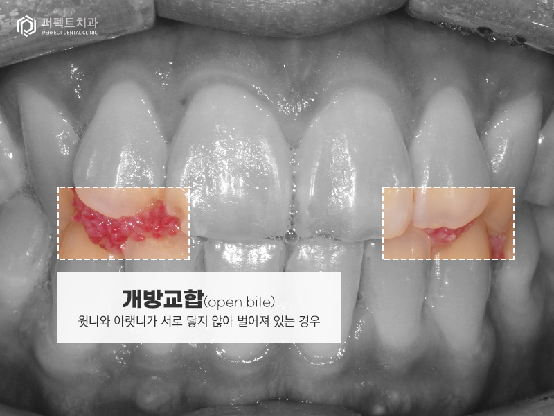 남자라미네이트, 폴리네이트 두가지 케이스 관련 이미지 3