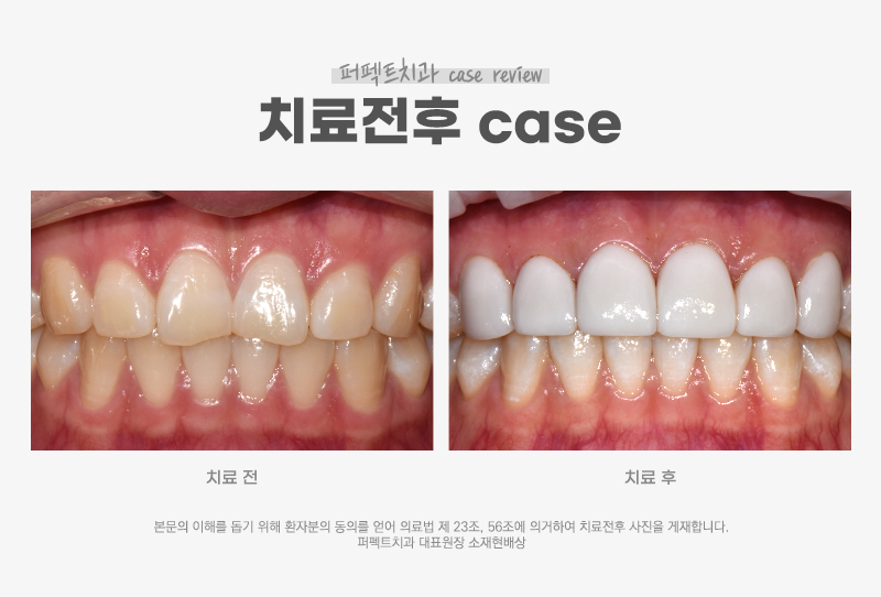 깨진앞니+나비치아 무삭제라미네이트 관련 이미지 7