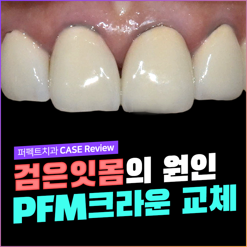 앞니 PFM크라운 가격 관련 이미지 1