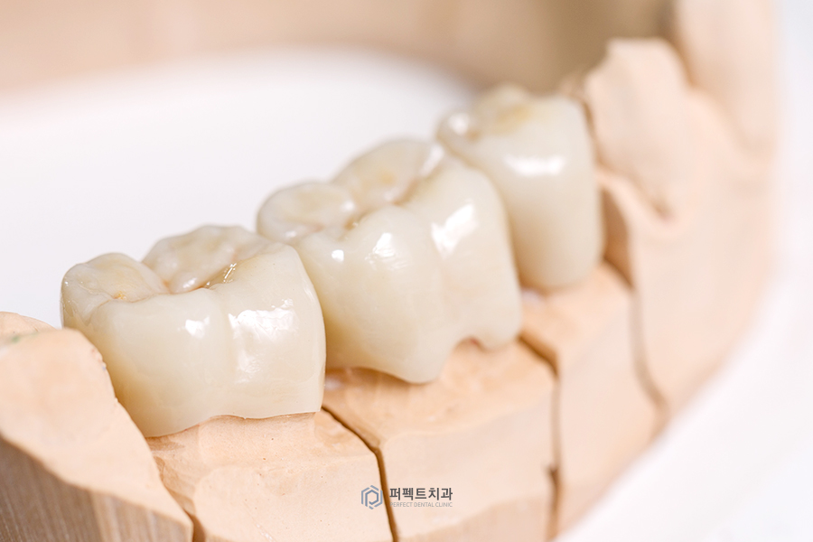 임플란트 한 번 심으면 평생 쓸 수 있나요?(2) 관련 이미지 1