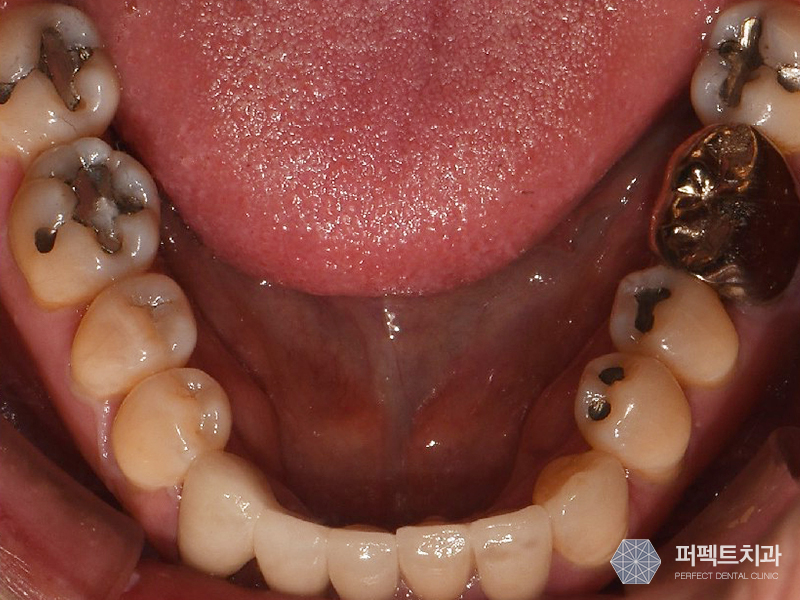 충치치료 치아크라운비용 관련 이미지 2