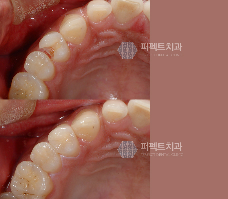 앞니충치, 어떤 치료를 받아야할까? 관련 이미지 3