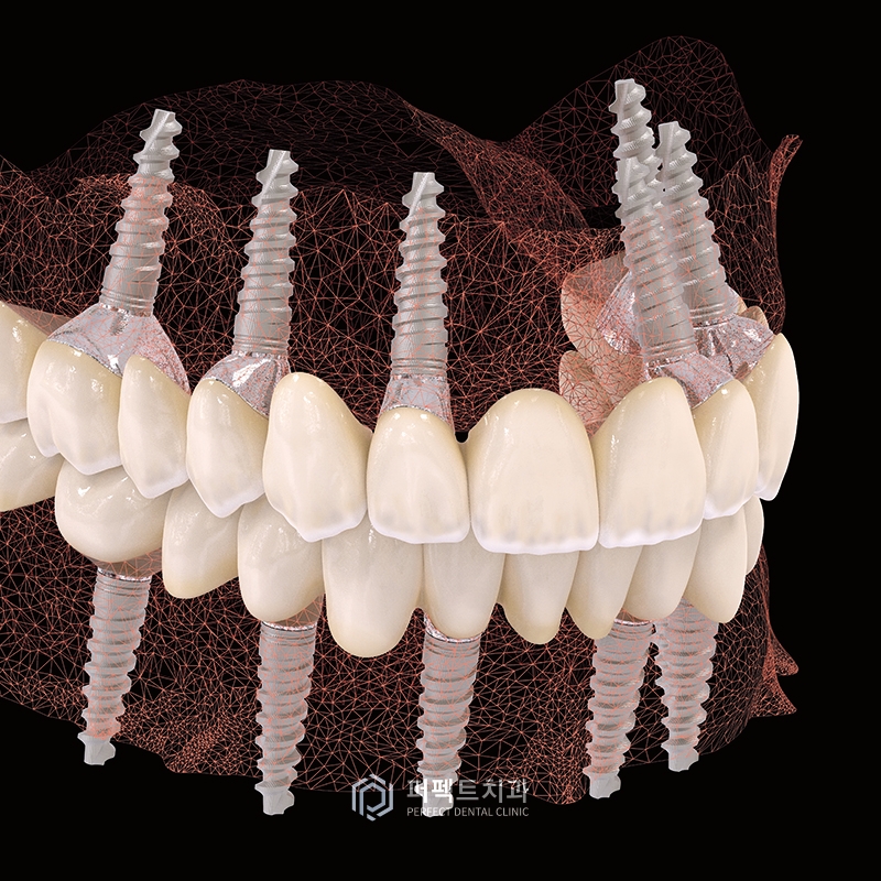 임플란트를 할 경우 발치한 공간은 비어있어야 하나요? 관련 이미지 4