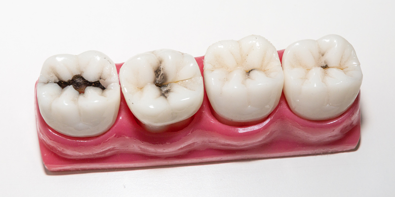 충치치료비용 알고 가자! 관련 이미지 2