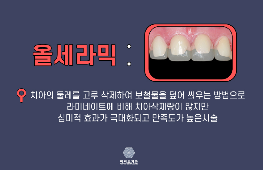 연예인 라미네이트 나도 할래!! 관련 이미지 3