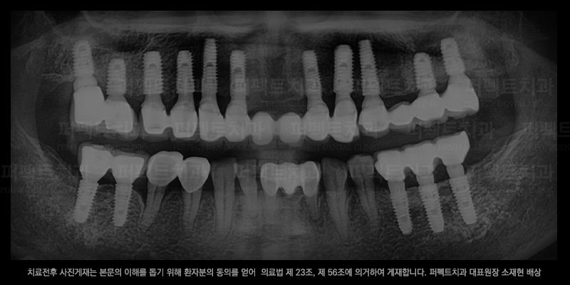 선릉역치과, 임플란트 선택 기준은? 관련 이미지 3