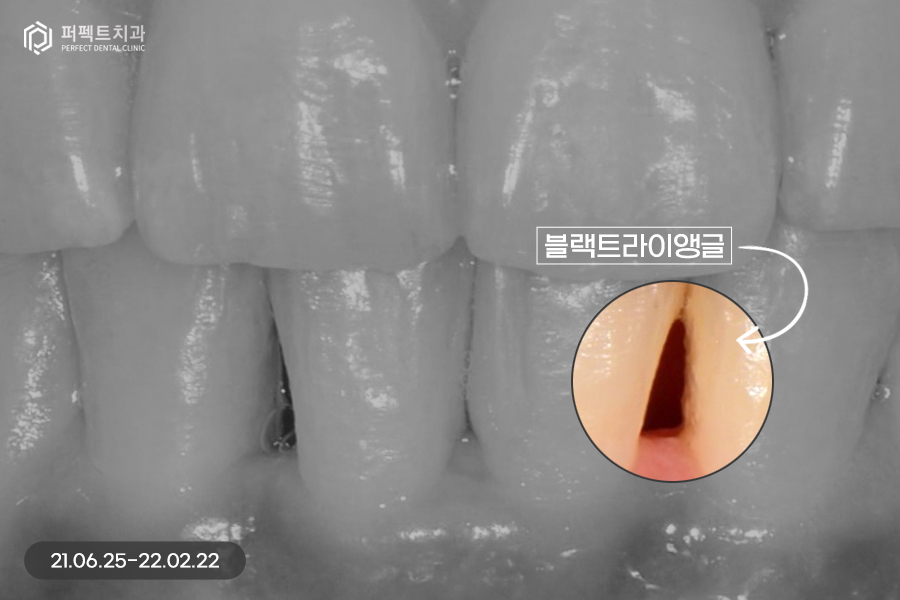 삐뚠 치아도 최소삭제가 가능하게👌🏻 교정 후 폴리네이트 관련 이미지 6