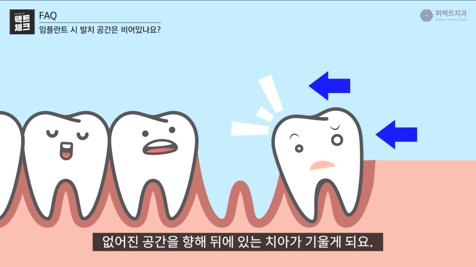 임플란트 후, 발치된 빈 공간이 걱정된다면? 관련 이미지 6