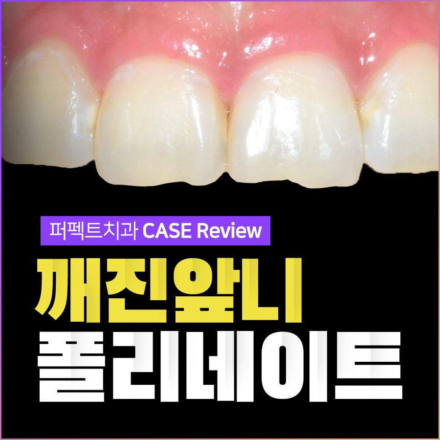 깨진 앞니 라미네이트 치료 CASE! 관련 이미지 1