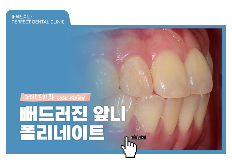 앞니 폴리네이트+치아미백 치료 관련 이미지 1