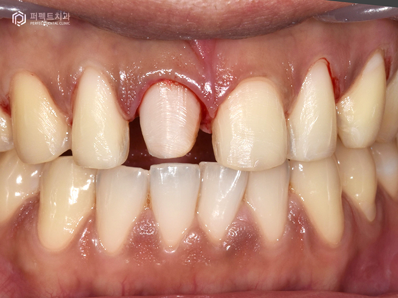 남자라미네이트, 폴리네이트 두가지 케이스 관련 이미지 10