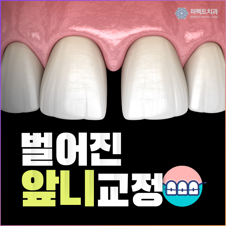 벌어진앞니교정, 원인부터 해결 방법까지 관련 이미지 1