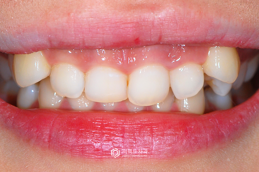 짧은 치아를 개선하는 방법은? 관련 이미지 3