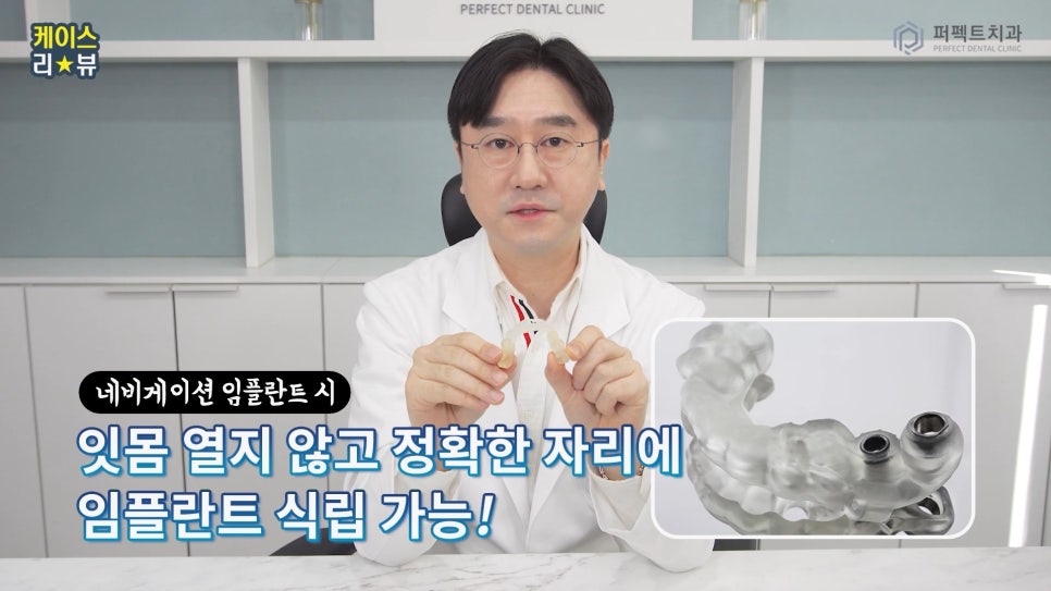 네비게이션 가이드로 전악임플란트를 20분만에? 관련 이미지 8