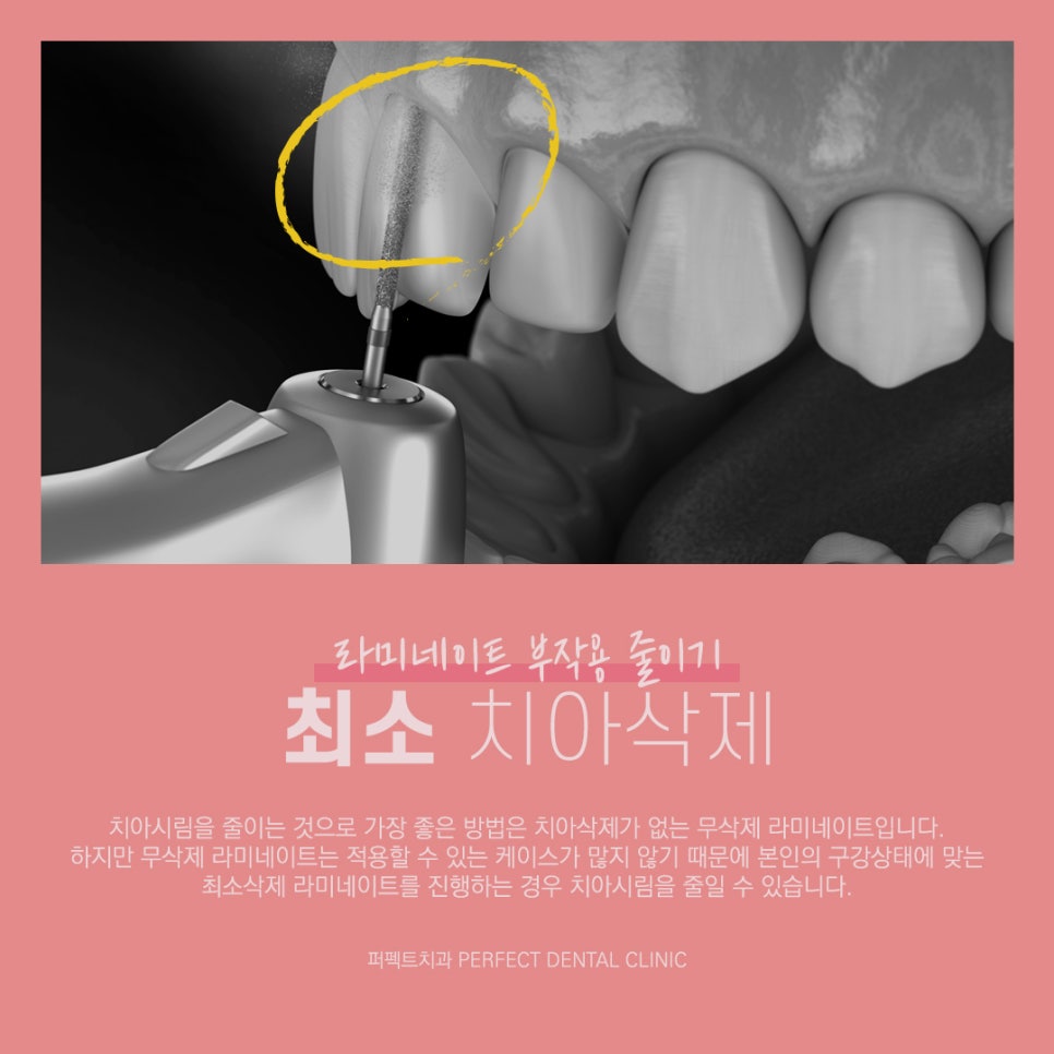 라미네이트 후 부작용은 어떤게 있을까? 관련 이미지 2