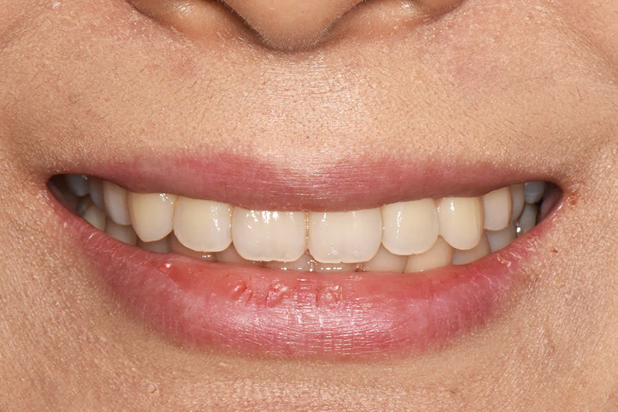 클리피씨를 이용한 부분교정, 얼마나 걸릴까? 관련 이미지 9