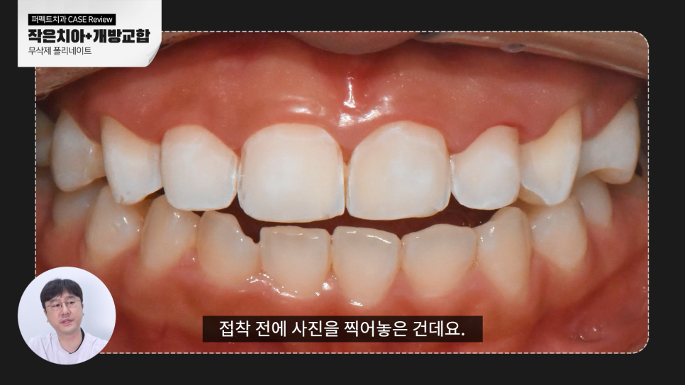 왜소치와 개방교합 문제를 한 번에 개선하다. 관련 이미지 4