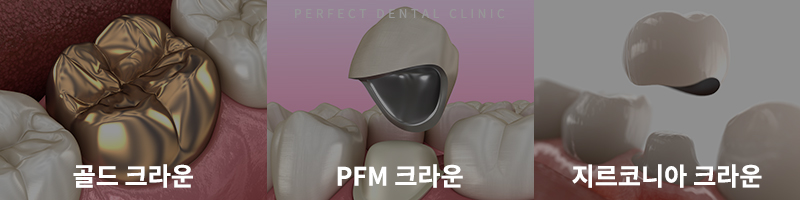 강남역치과 크라운 치료 가격 관련 이미지 3