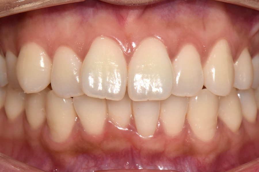 클리피씨를 이용한 부분교정, 얼마나 걸릴까? 관련 이미지 2