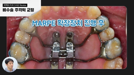 비수술 주걱턱 교정 결과 관련 이미지 4