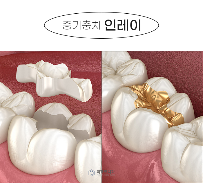 미룰수록 어려운 충치치료, 초기에 치료해요! 관련 이미지 6