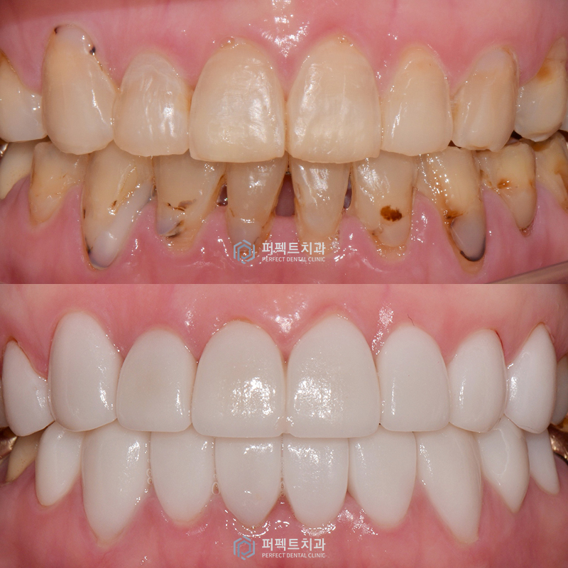 무삭제 라미네이트 리얼 후기 관련 이미지 1