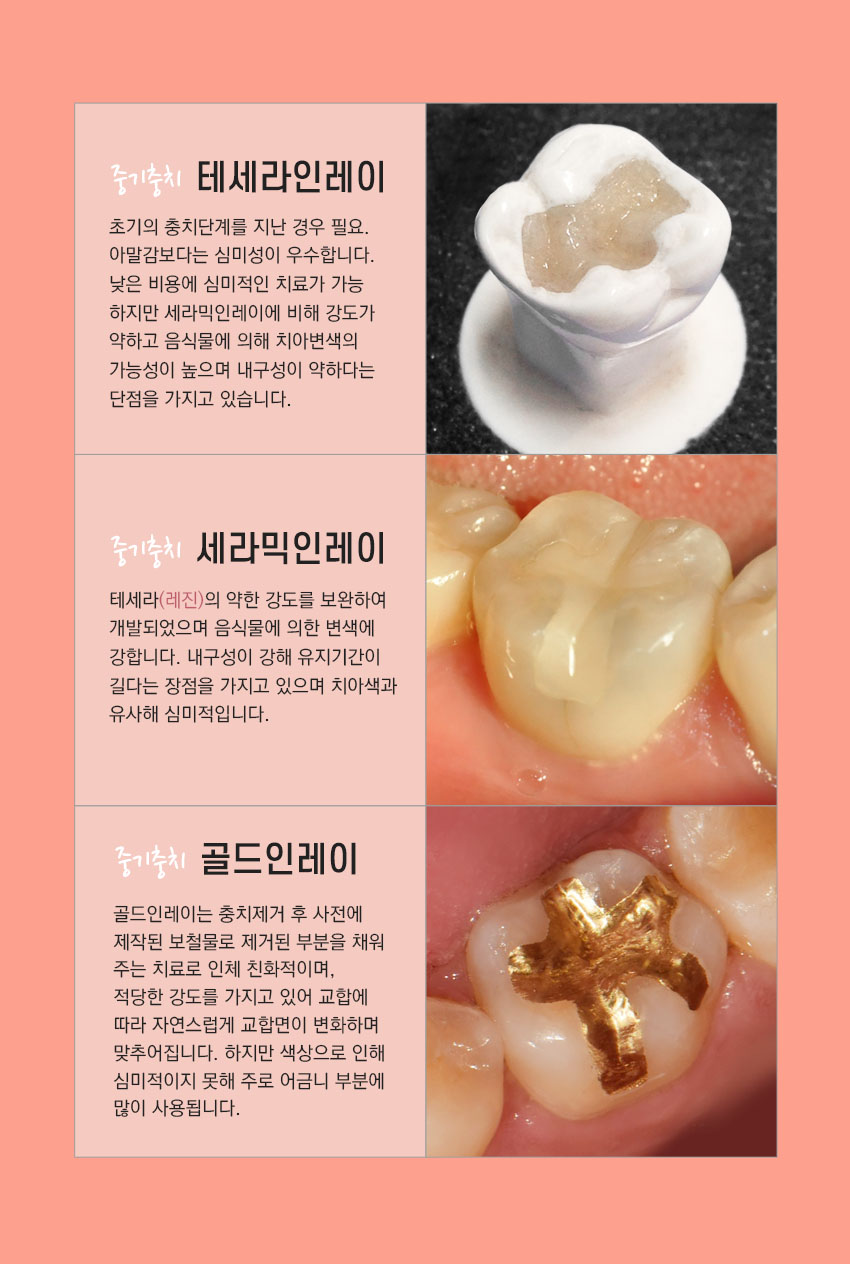 세라믹인레이 충치치료 비용 관련 이미지 3