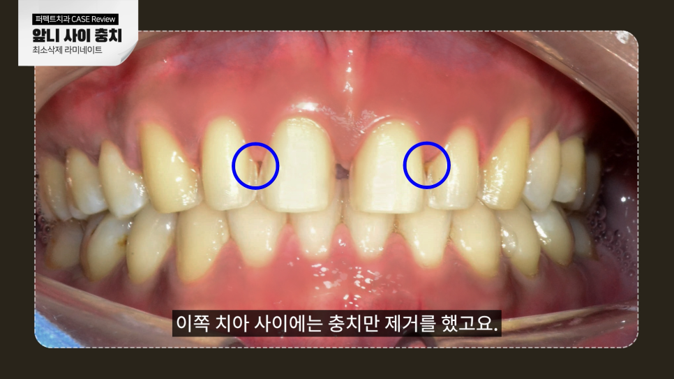앞니 사이 충치, 어떻게 치료해야 티 안 날까? 관련 이미지 9