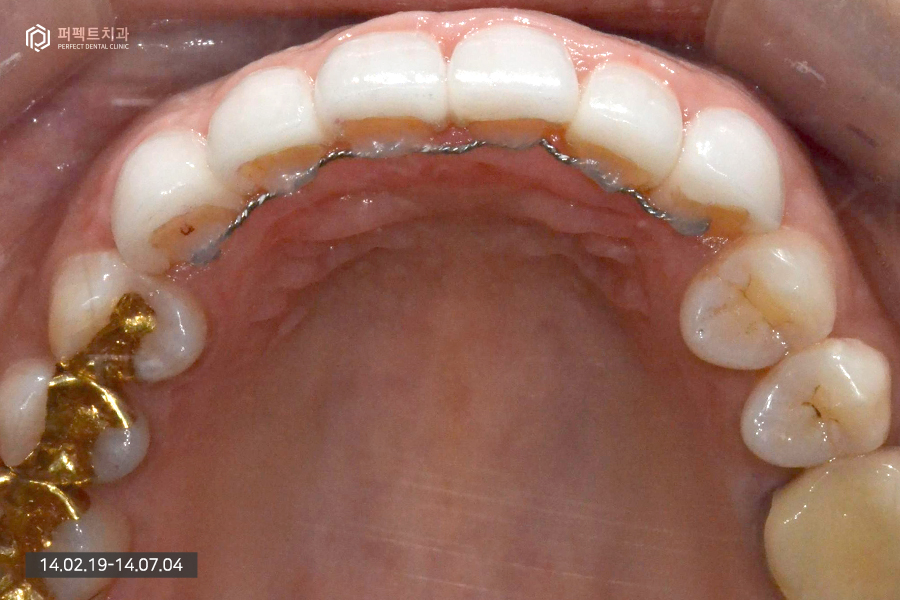 충치치료+교정 후 라미네이트, 세가지 복합적인 치료의 기간은?! 관련 이미지 7