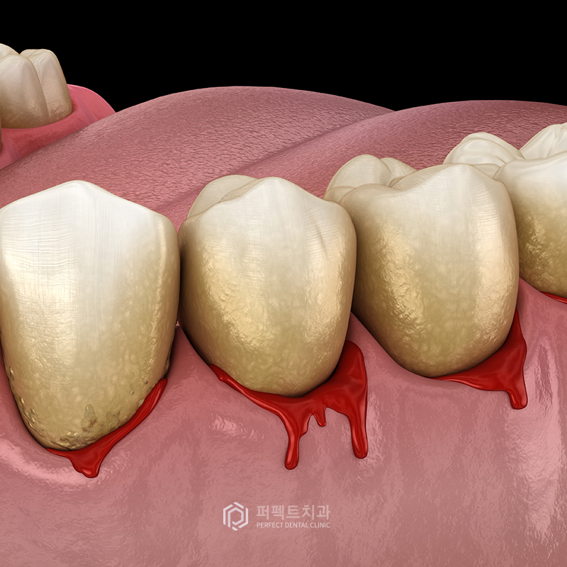 스케일링을 하면 치아가 깎이나요? 관련 이미지 4