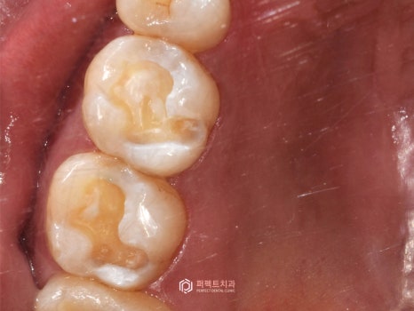 충치치료 인레이, 어떤 경우에? 관련 이미지 6