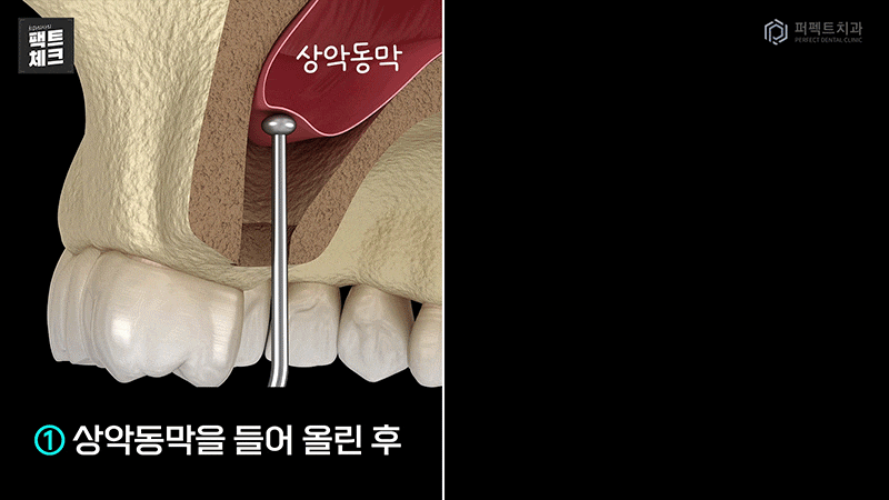 임플란트 뼈이식 질문 BEST 모음집_zip ② 관련 이미지 1