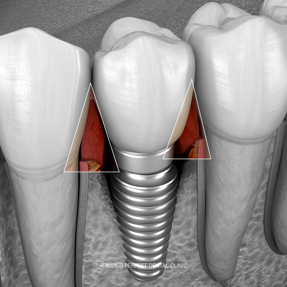 임플란트 후 바로 밥 먹을 수 있나요?(Feat.임플란트 후 주의사항) 관련 이미지 4