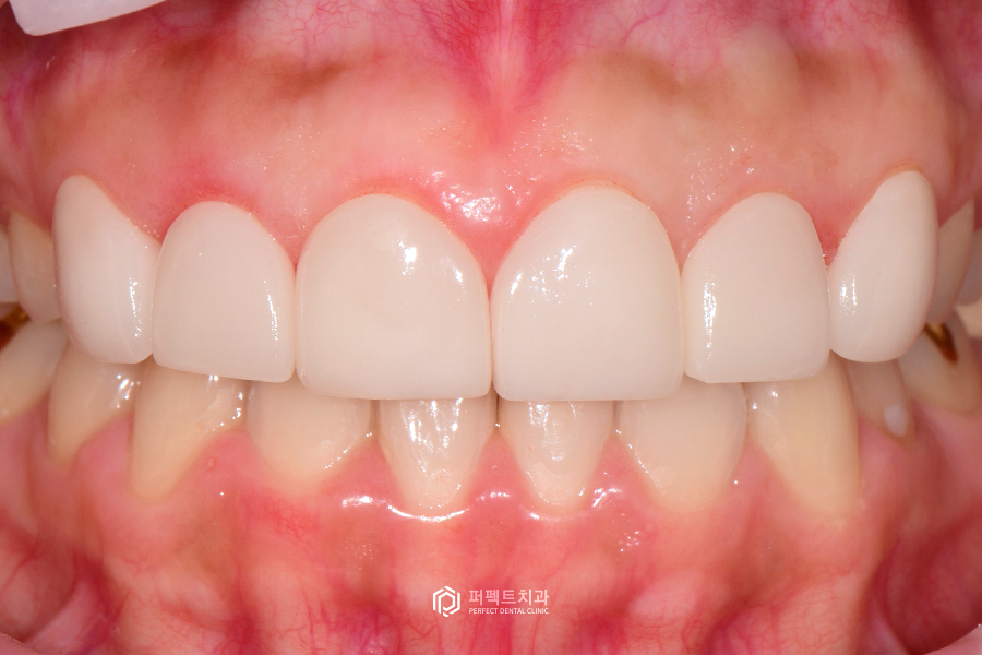 3일만에 라미네이트 교체를 결정한 이유는?😲 관련 이미지 4