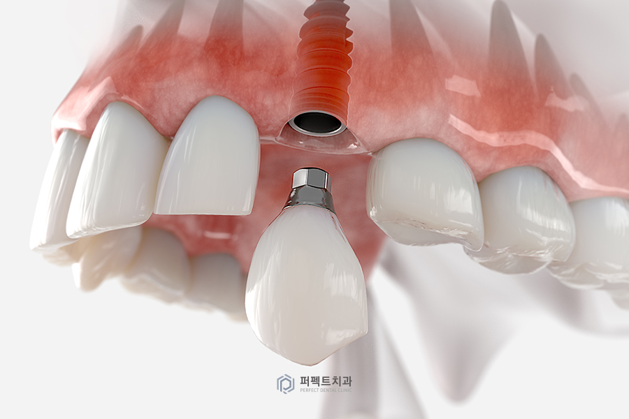임플란트 수술 부위에 음식물이 끼었다면? 관련 이미지 1