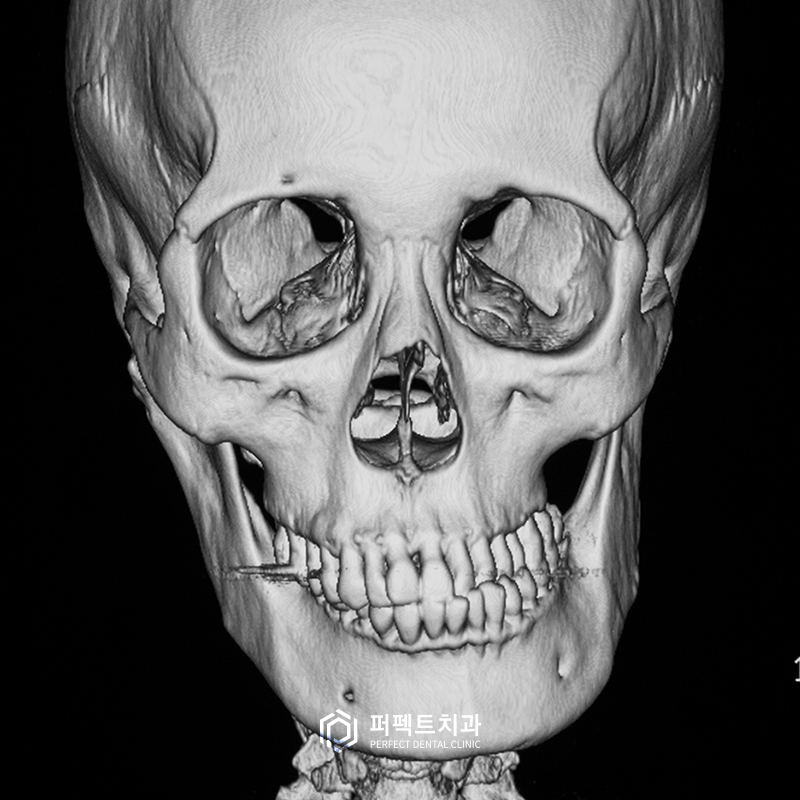 치아교정 후 재교정이 가능할까요? 관련 이미지 3