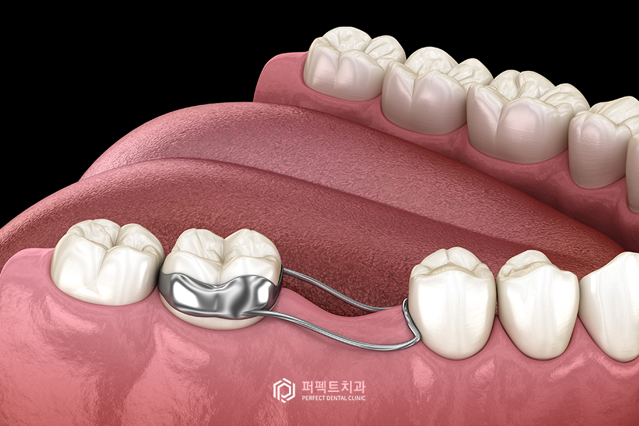 임플란트도 나이 제한이 있다?① - 학생편 관련 이미지 6