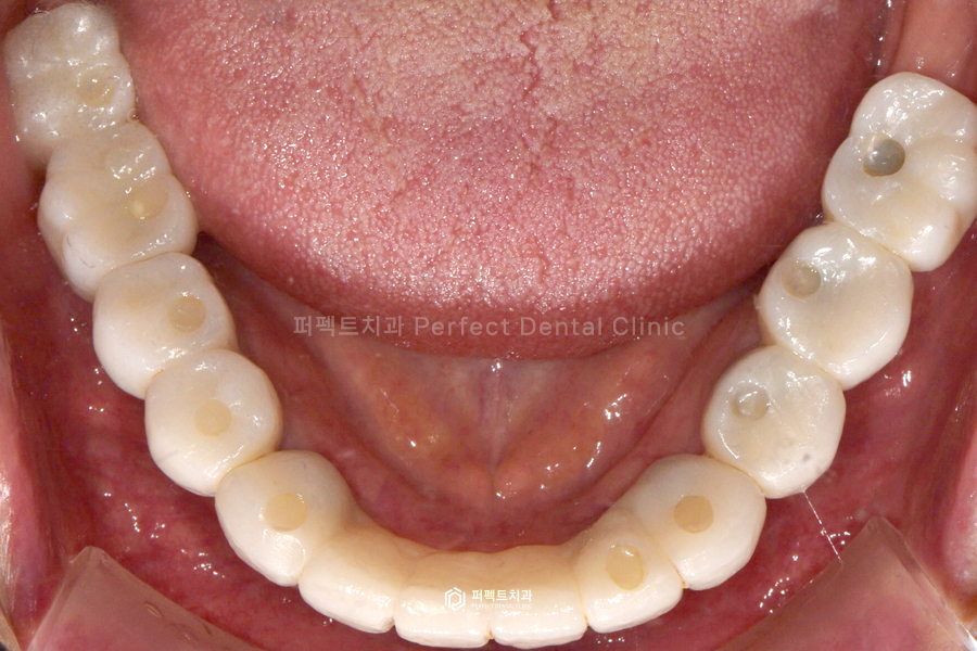 윗니 전체 신경치료 했다고?😱 교합평면이 뭐길래 관련 이미지 13
