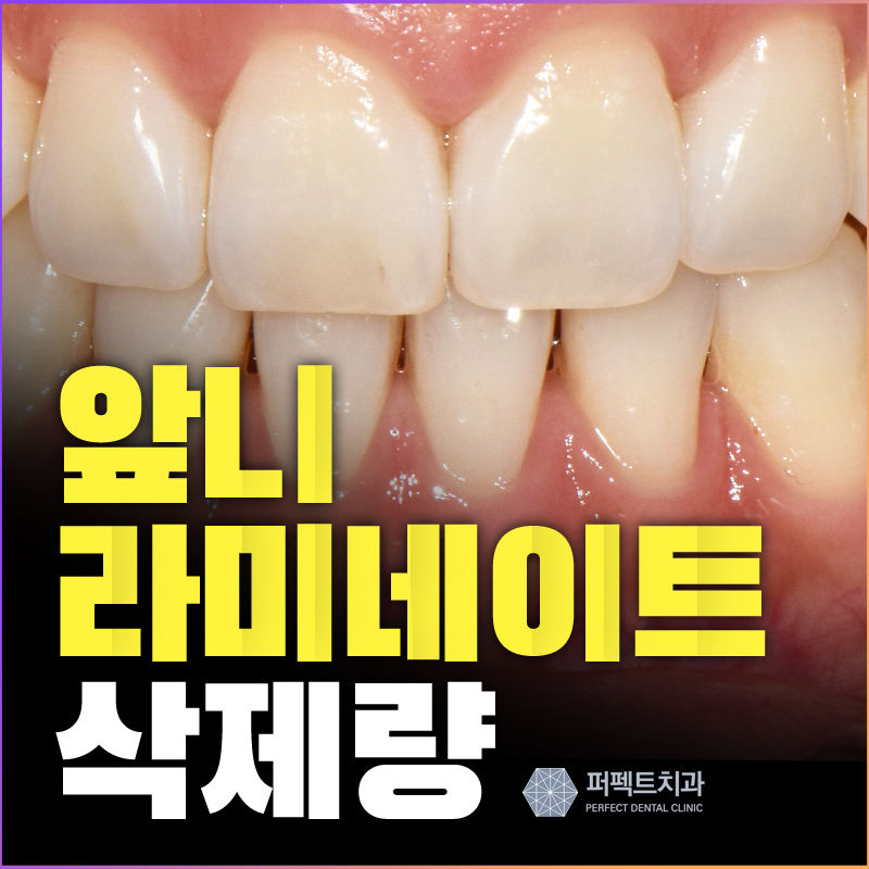 앞니라미네이트 치아삭제량 궁금해? 관련 이미지 1
