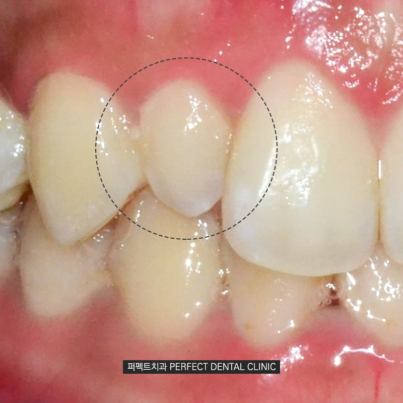 큰 치아도 라미네이트가 가능할까요? 관련 이미지 3