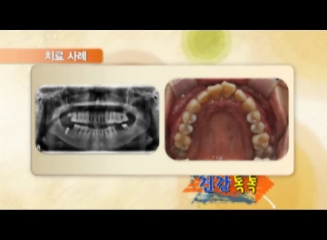 MTN 머니투데이 건강톡톡 / 치주질환과 뼈이식 임플란트 관련 이미지 9